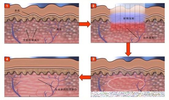 天大蝶变独特项目美国雅光智能射频紧肤介绍