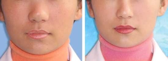 膨体隆鼻价格,膨体隆鼻对比照片,膨体隆鼻对比图,膨体隆鼻对...