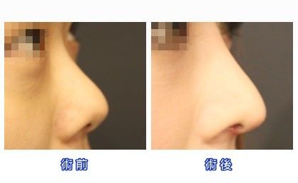 性感女神李孝利 坦诚<em>隆鼻</em>成为韩国整容范本_新