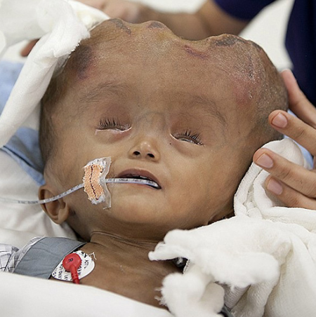 脑积水手术费图片