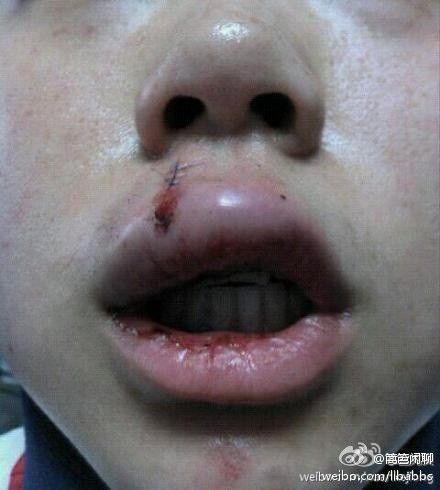 图说:出租车追尾后,陈小姐撞上副驾驶座后背广告屏,唇部裂伤,缝了多针。网友供图(请私信@新民晚报新民网以奉稿酬) 图说:出租车追尾后,陈小姐撞上副驾驶座后背广告屏,唇部裂伤,缝了多针。网友供图(请私信@新民晚报新民网以奉稿酬)
