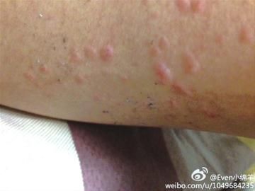 电池爆炸溅伤蒋小姐(当事人供图) 电池爆炸溅伤蒋小姐(当事人供图)