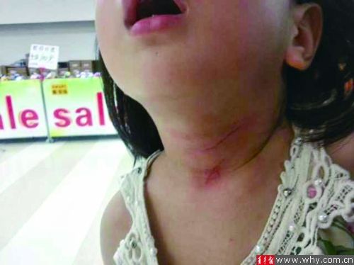 ▲小孩脖子上两道伤口触目惊心。 受访者供图 ▲小孩脖子上两道伤口触目惊心。 受访者供图