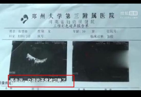 10岁女孩做阑尾手术子宫被切除(2)