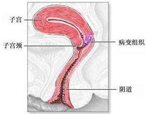 美国发布新版宫颈癌筛查指南_新浪上海_新浪