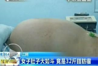 女子肚子长32斤脂肪瘤 误以为是发胖