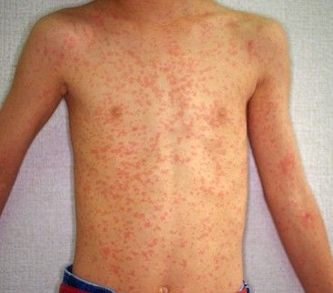 几个月宝宝会出疹子 U8723P18DT20140108183239.jpg