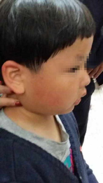 小男孩脸上有明显被打过的红色印记。图片来源:微博图 小男孩脸上有明显被打过的红色印记。图片来源:微博图