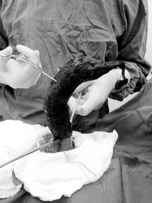 异食癖:5岁女童胃里取出一团<em>头发</em>_新浪上海_新