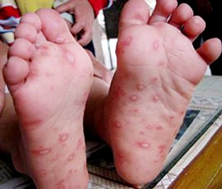病毒性疱疹初期症状有哪些