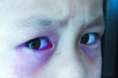 以结膜高度充血,常见结膜下出血及角膜上皮点